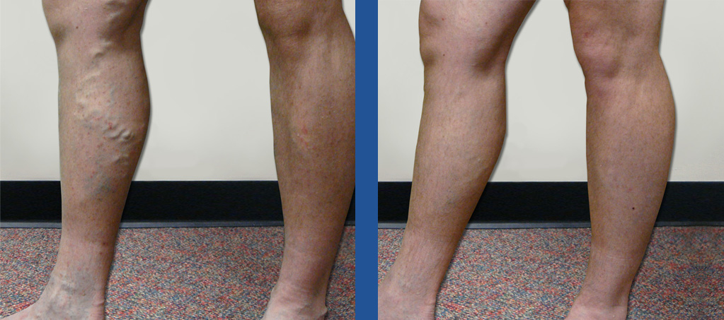 Spider vein removal deals nyc