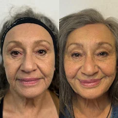Before-and-after facial rejuvenation results at Good Skin Aesthetics.