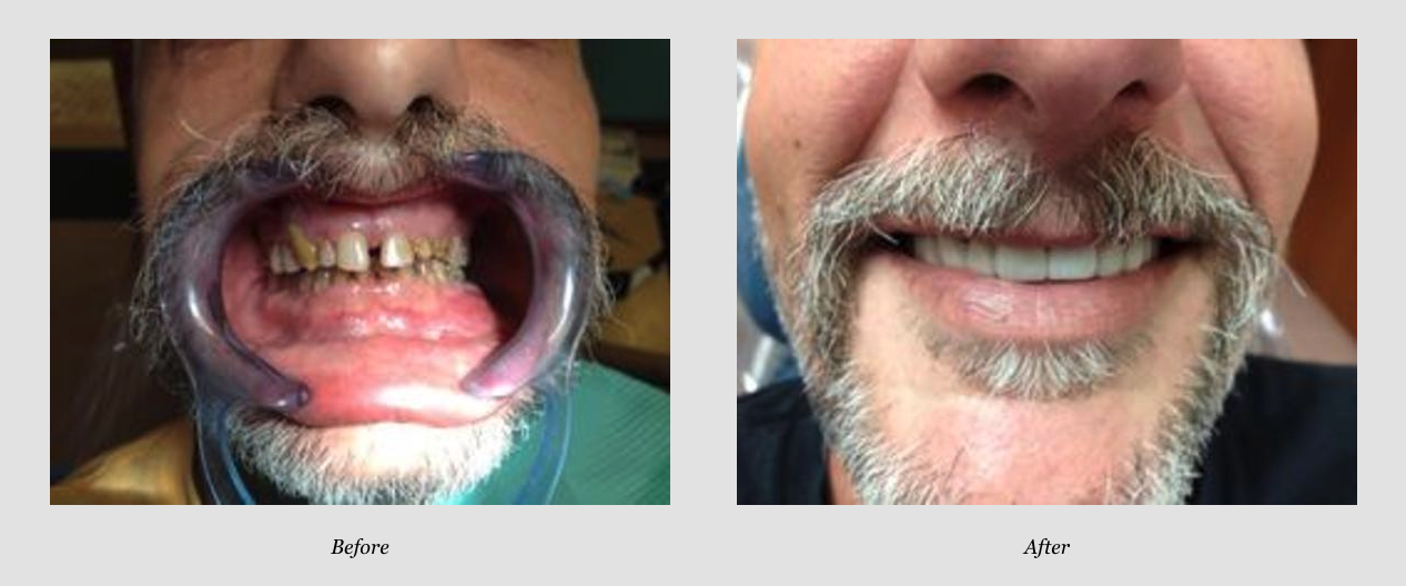 Full Mouth Restoration Before & After from Hawaii Pacific Dental Group, Inc. | Honolulu, HI