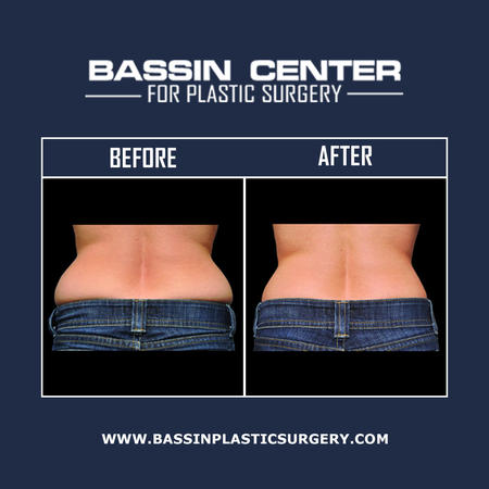 Liposuction can eliminate pockets of stubborn fat that are resistant to traditional weight loss methods. At Bassin Plastic Surgery, we offer lipo surgery in Orlando with minimally invasive liposuction solutions, such as Aqualipo® & Smartlipo™, for Orlando patients looking to sculpt the abdomen, flanks, thighs, legs, arms, back, & more. Laser fat removal is available to remove unwanted fat & tighten loose skin in one procedure.