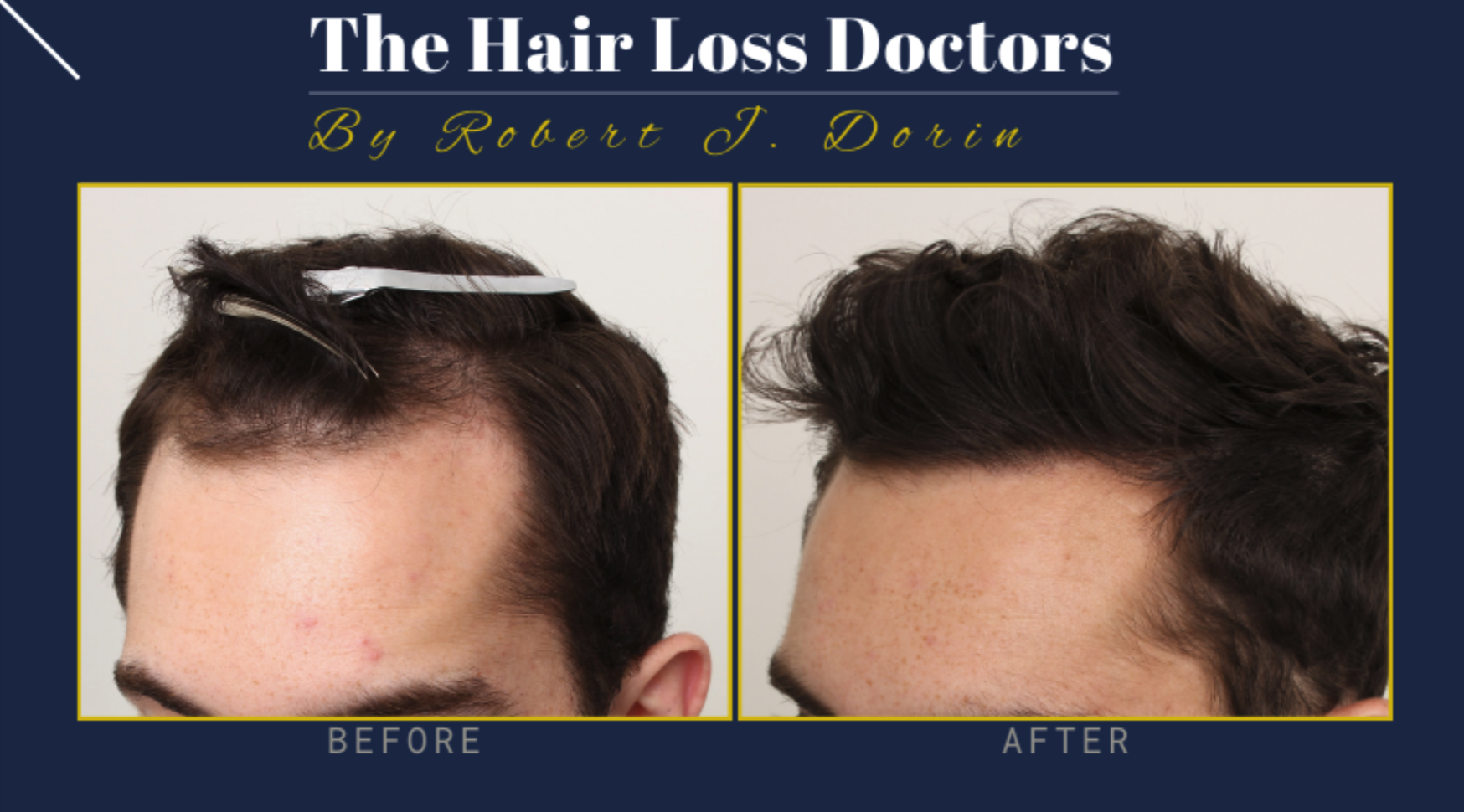 Best 30 Hair Replacement in Long Island NY with Reviews