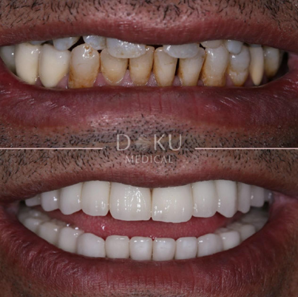 Bild 2 Veneers & Zahnimplantate – Zähne machen lassen in der Türkei mit Fly2Smile in Berlin