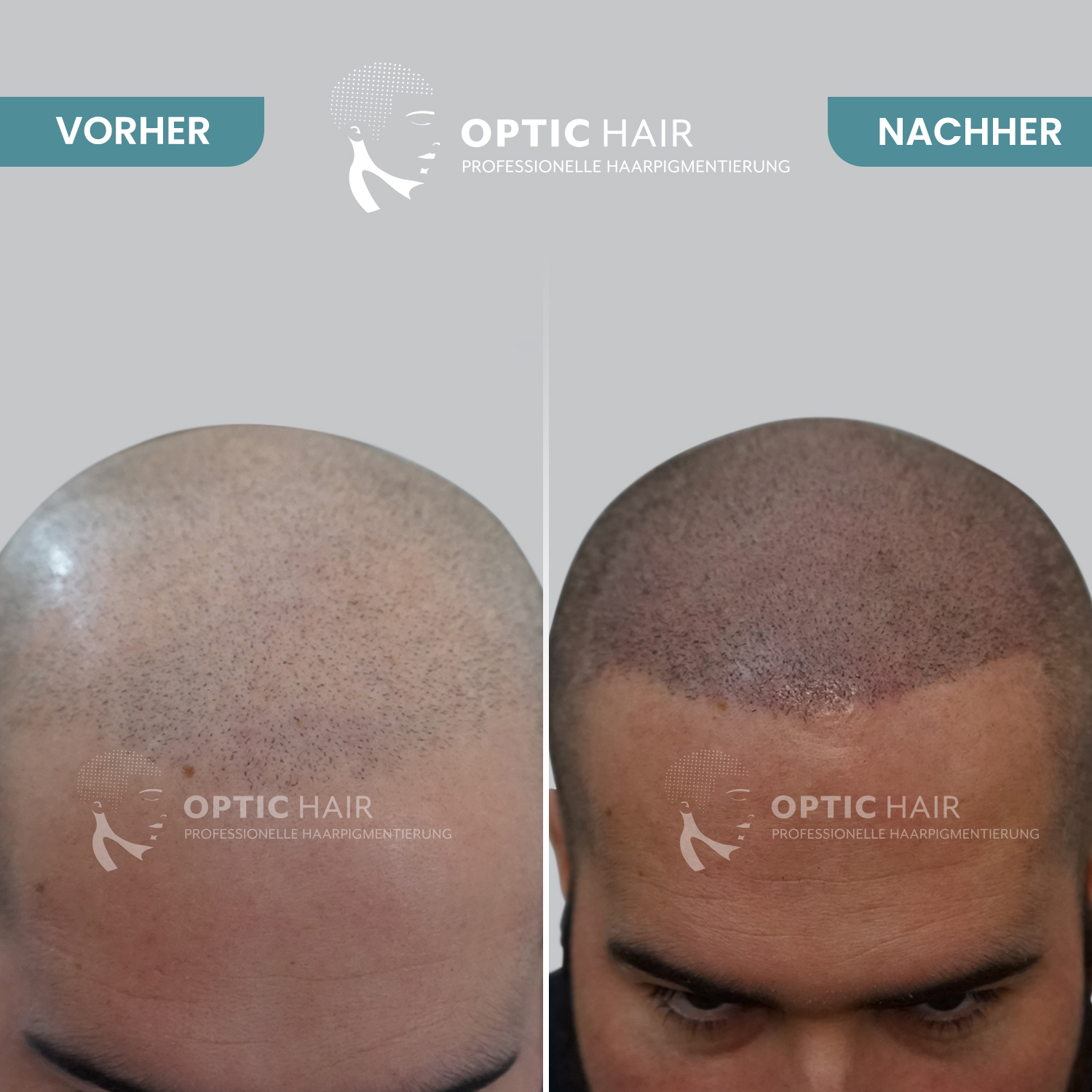 Haarpigmentierung Vorher Nachher Bilder Optic Hair