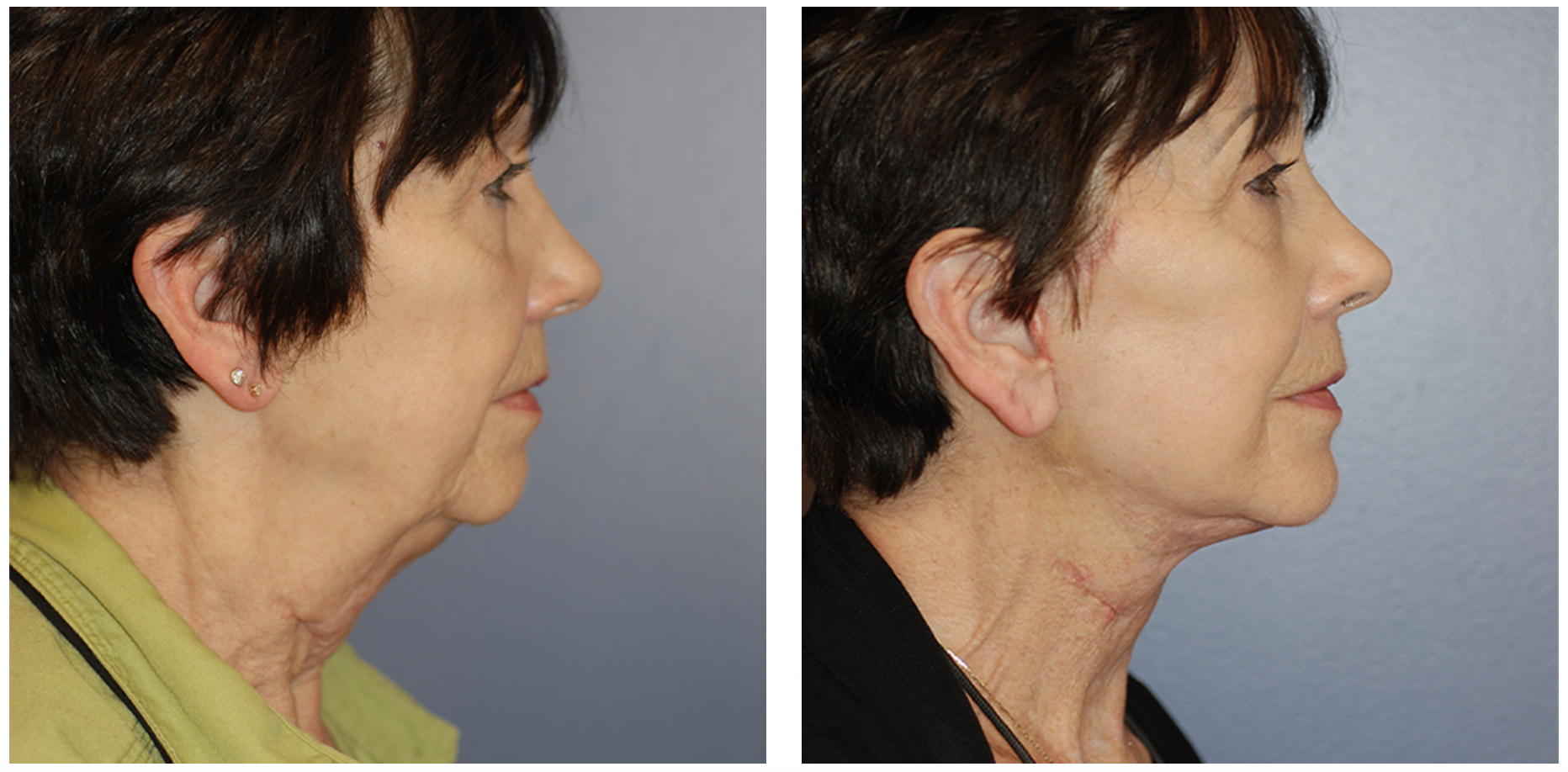 Facelift in San Francisco, CA with Dr. Ginger Xu.