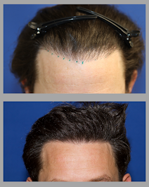 Images BKS Hair Restoration