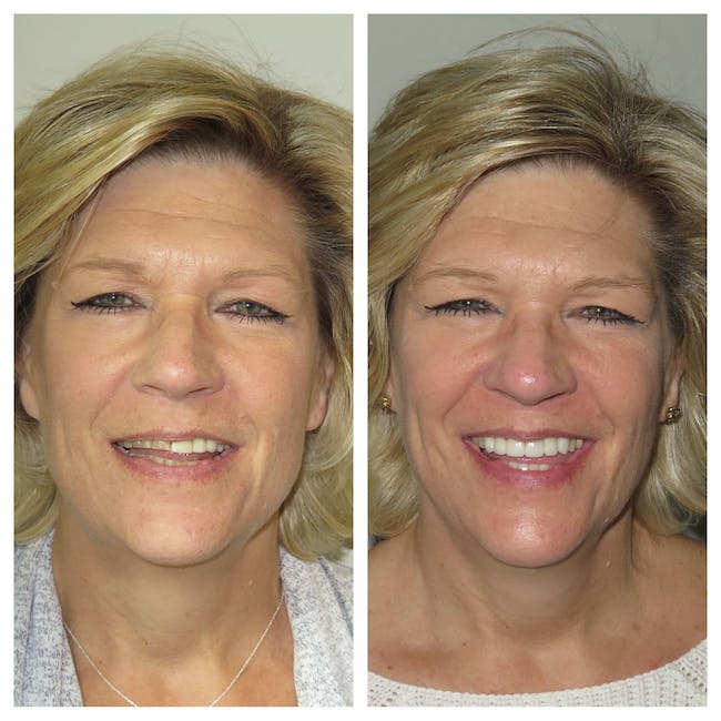 Before & After Results at White Pine Dental | Herriman, UT
