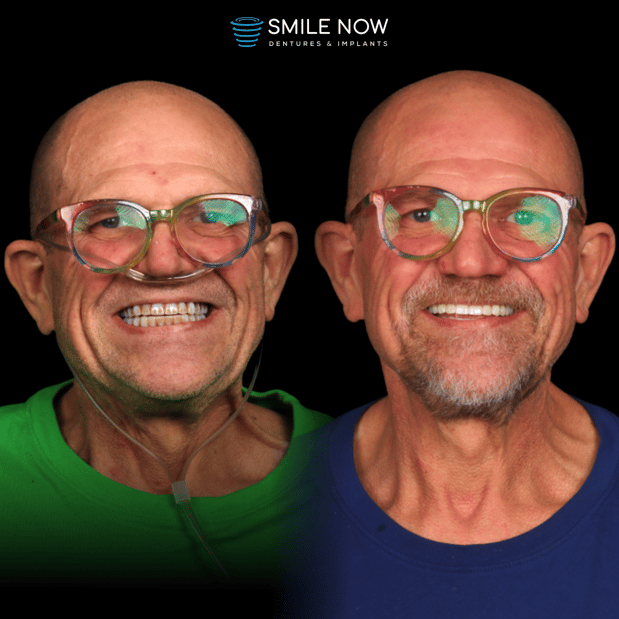 Images Smile Now Milwaukee Dentures and Implants