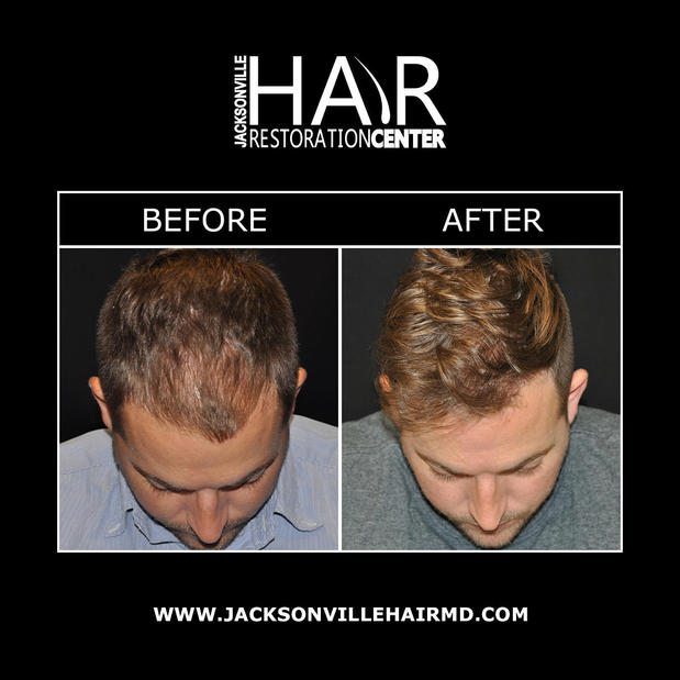 Images Jacksonville Hair Restoration Center