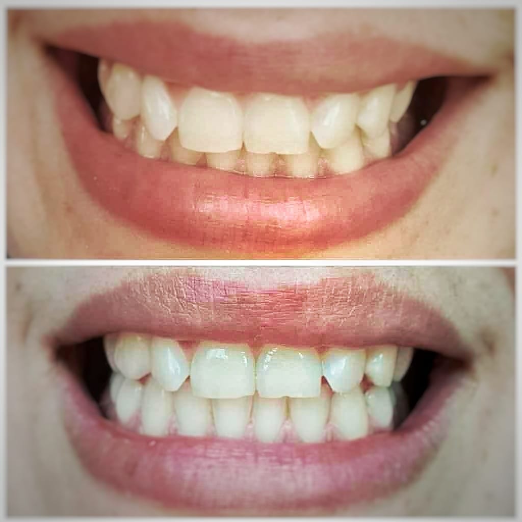 Images Fv Láser Nails Beauty