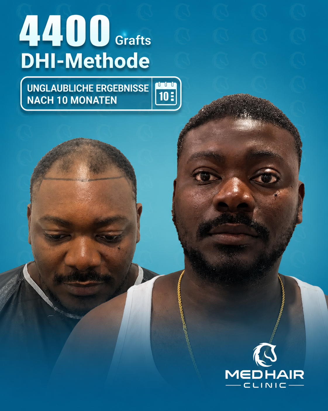 MedHair Clinic | Haartransplantationen in der Türkei Istanbul, Höninger Weg 176 in Rodenkirchen