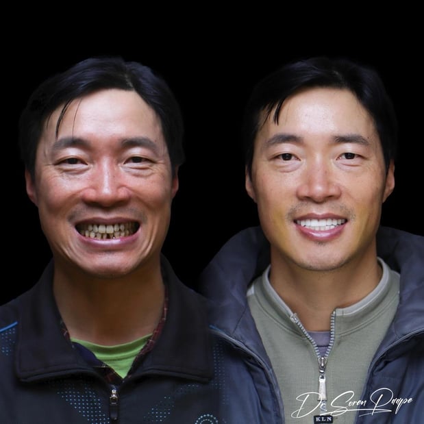 Images Smile Now Denver Dentures and Implants