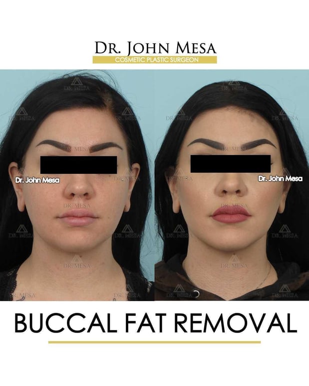 Images Dr. John Mesa, MD: Plastic Surgeon NYC, Buccal Fat Removal, Chin Liposuction, Facelift, Facial Masculinization, Chin Implant