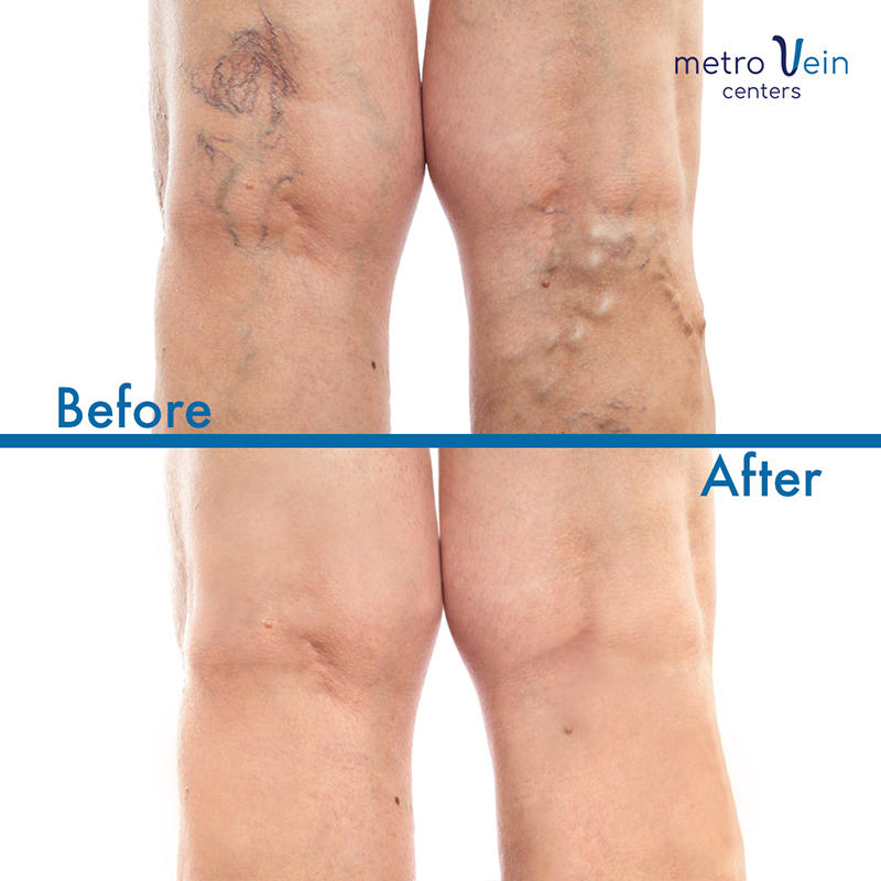 Metro Vein Centers Medical Clinic Hackensack New Jersey