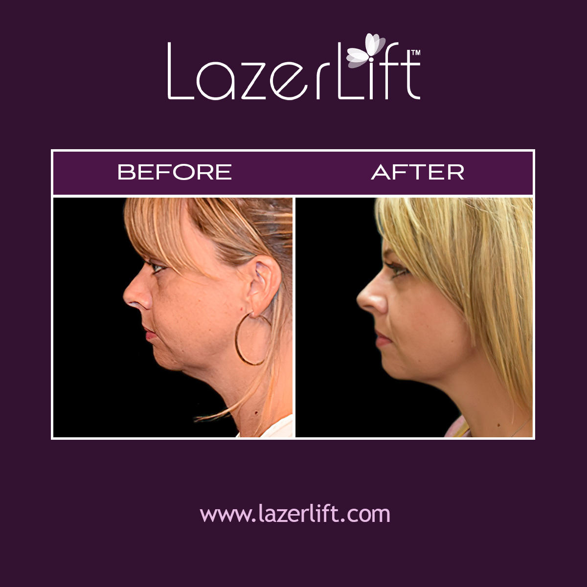 Our skilled plastic surgeons offer laser face lift in Orlando. LazerLift® is successful in tightening the skin on the face to create a youthful-looking appearance. LazerLift® targets beneath the surface of the skin to plump cheeks, reduce fine lines, and lift the cheekbones. The LazerLift® procedure is minimally invasive and provides patients with long-lasting results.