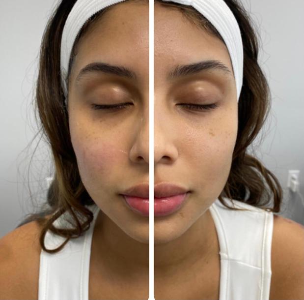 Images Skin Tightening, Botox and Lip Fillers by Skinsation LA