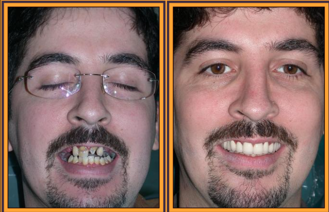 Before & After Results at Astoria Dental Group | Astoria, NY