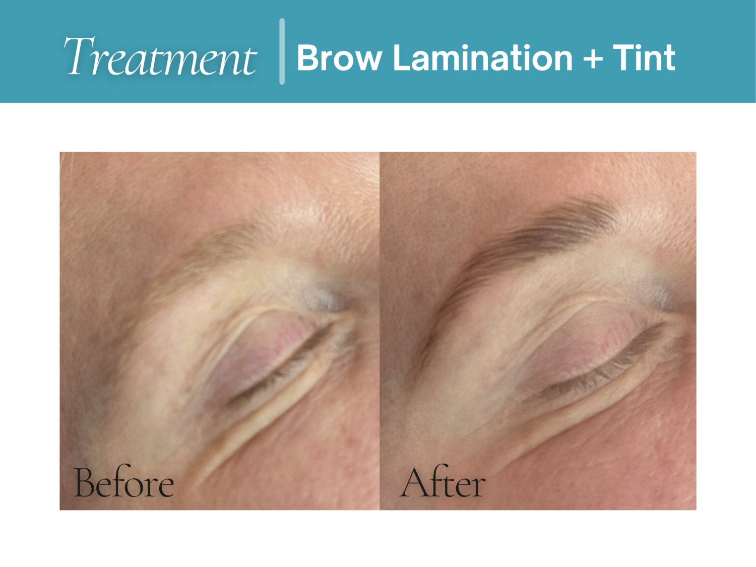 Before-and-after results for Brow Lamination And Tint at Pureesthetics show a close-up transformation of the eyebrow area, with the before image displaying a lighter, less defined brow and the after image showing a fuller, darker, more sculpted shape. This result image from the Brows and Lashes section highlights the kind of brow enhancement services Pureesthetics features in Birmingham, Alabama.