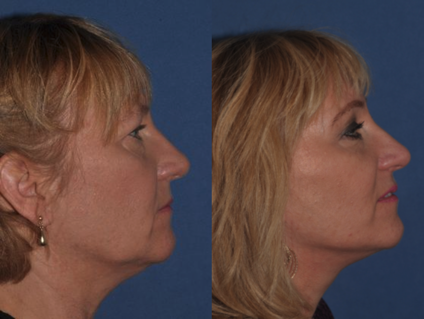 Brow / Facelift Before & After at Clinic of Facial Plastic Surgery | Buffalo, NY
