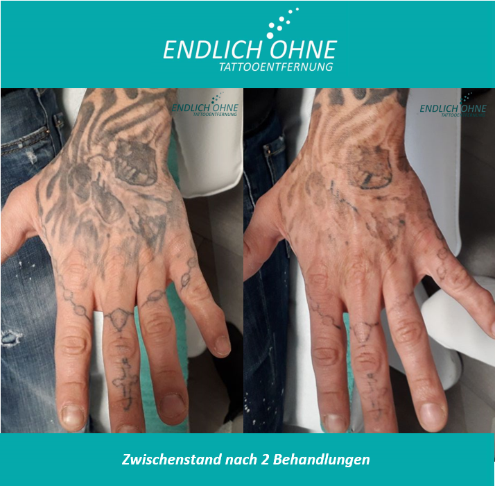 Bilder ENDLICH OHNE Tattooentfernung / Permanent Make-up Entfernung Stuttgart