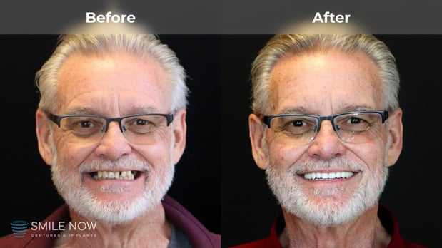Images Smile Now Eugene Dentures and Implants