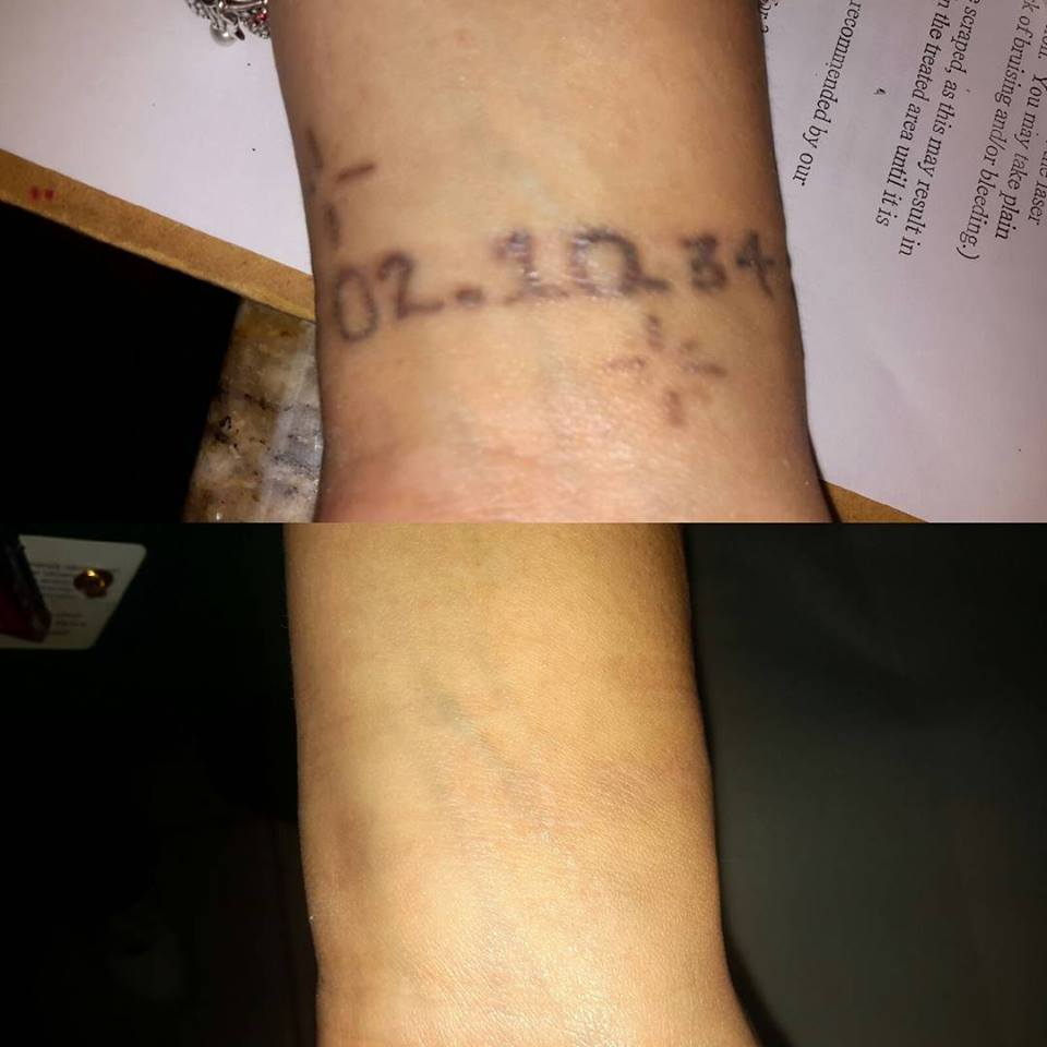 Winter Park Tattoo Removal Photo