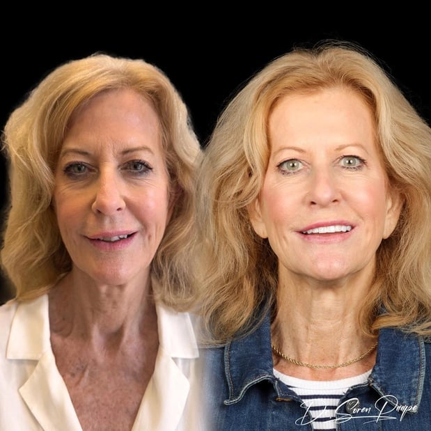 Images Smile Now Denver Dentures and Implants