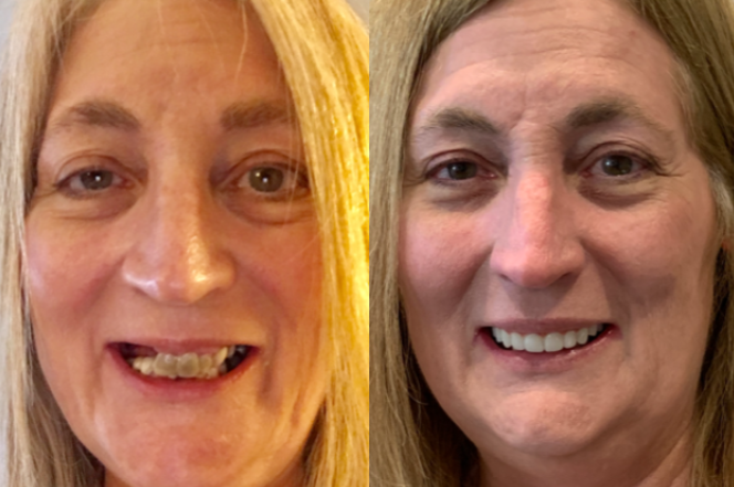 Before & After Results for Koyfman Dental | Orlando, FL