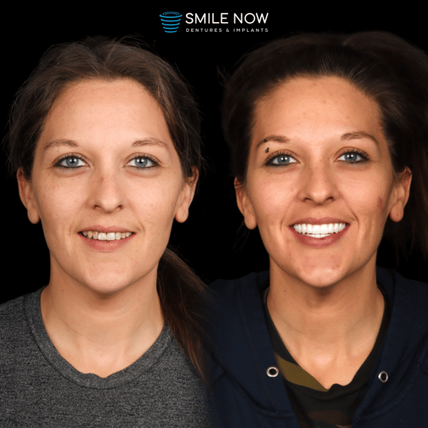 Images Smile Now Colorado Springs Dentures and Implants