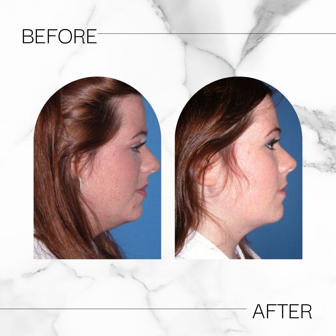 Before & After chin liposuction results at Devlin Cosmetic Surgery: Michael Devlin, M.D. | Little Rock, AR