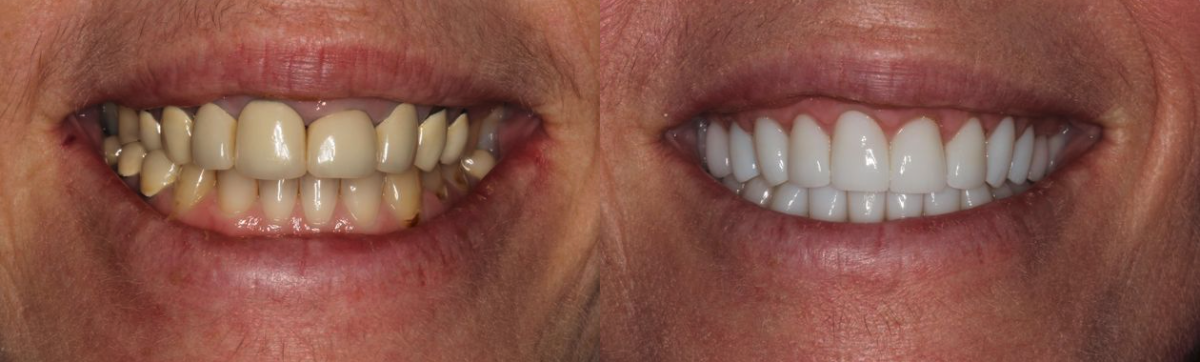 Before & After from Alafaya Family Dentistry | Oviedo, FL