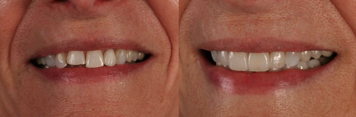 Porcelain Veneers Before & After at Schmitt Prosthodontics | Altamonte Springs, FL