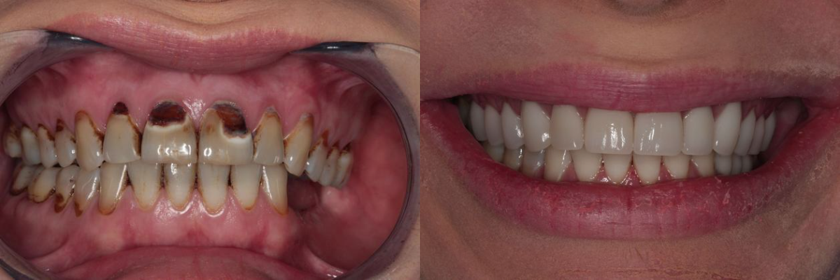 Before & After from Southern Dental Implant Center | Cordova, TN