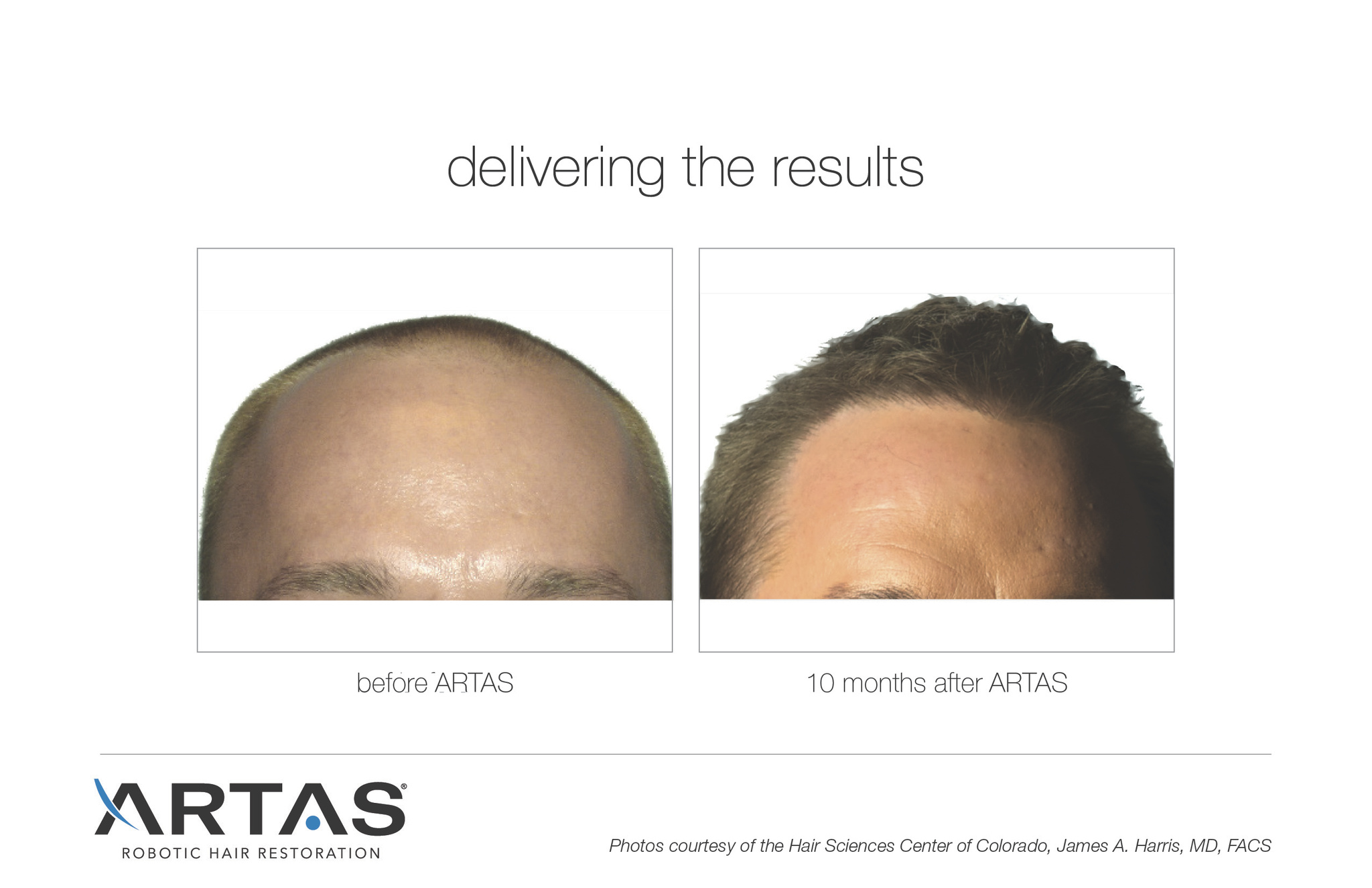 Images Follicl MD - Hair transplant - Greffe de cheveux
