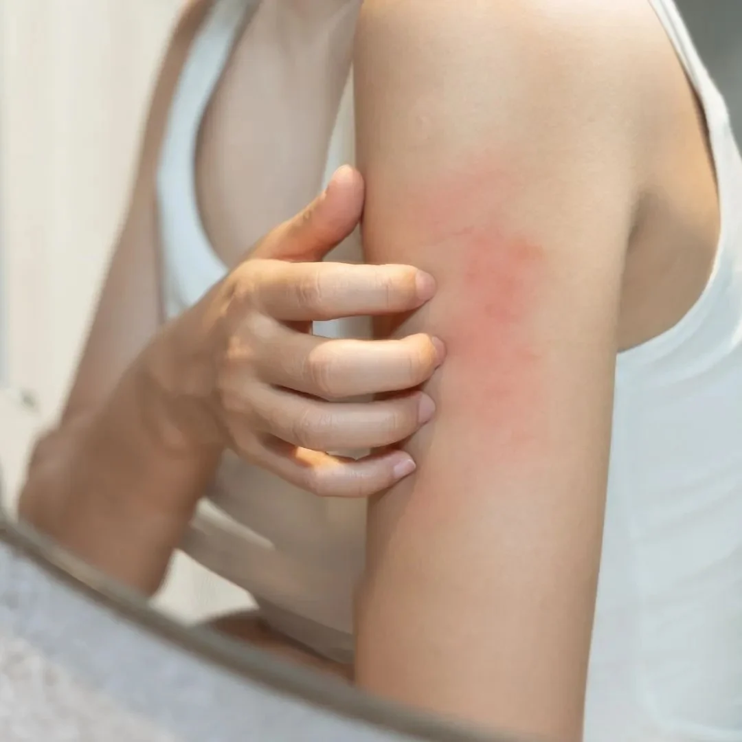 Skin Rashes & Infections – Calm Symptoms and Support Healing