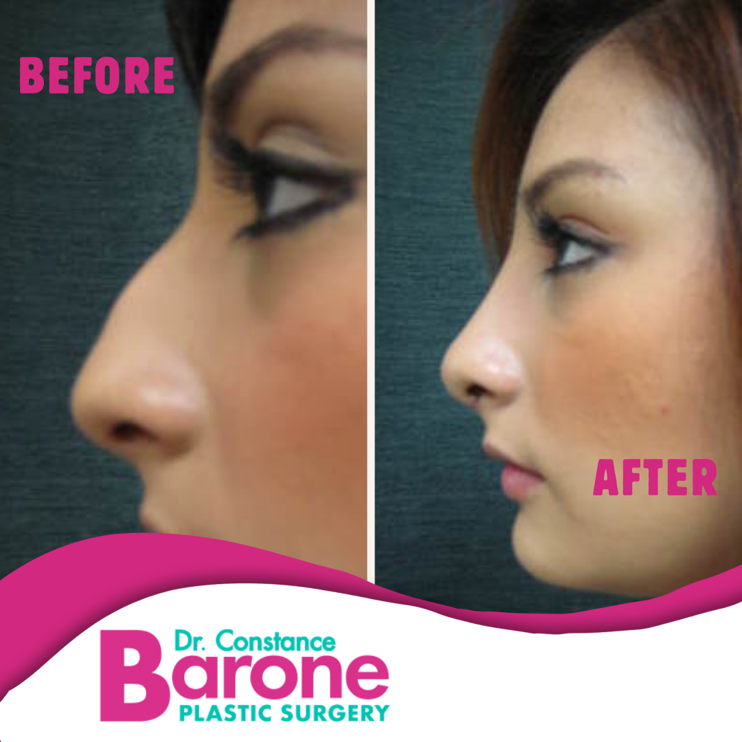 Before & After Results with Dr. Constance Barone | San Antonio, TX