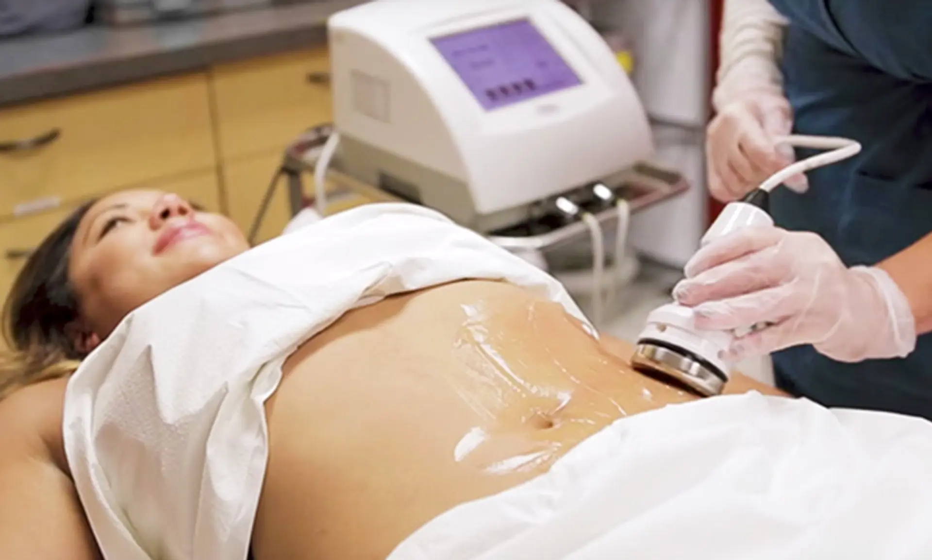 A woman lies on her back with a white sheet covering her, receiving a medical or cosmetic treatment on her abdomen. A device with a silver and white handpiece is being applied to her stomach by a person wearing clear gloves and a dark blue scrub top. In the background, a white medical device with a purple screen and buttons is visible, along with what appears to be a medical cart. The woman's face is turned slightly upward, and she has a relaxed expression. The area being treated on her abdomen is covered in a clear gel or lotion.