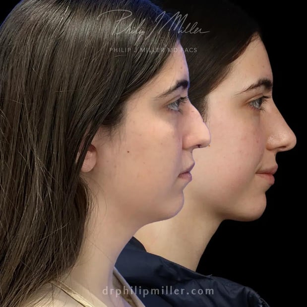 Images Dr. Philip Miller - #1 Facelift and Rhinoplasty Surgeon in New York