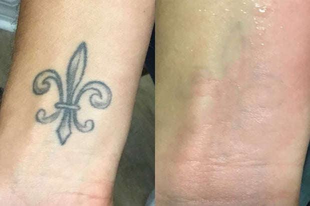 Images TakeTatt Tattoo Removal