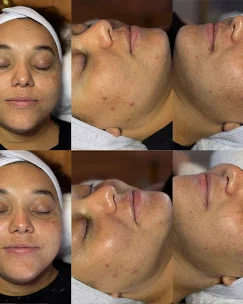 Before-and-after skin results from a skincare treatment at Good Skin Aesthetics.