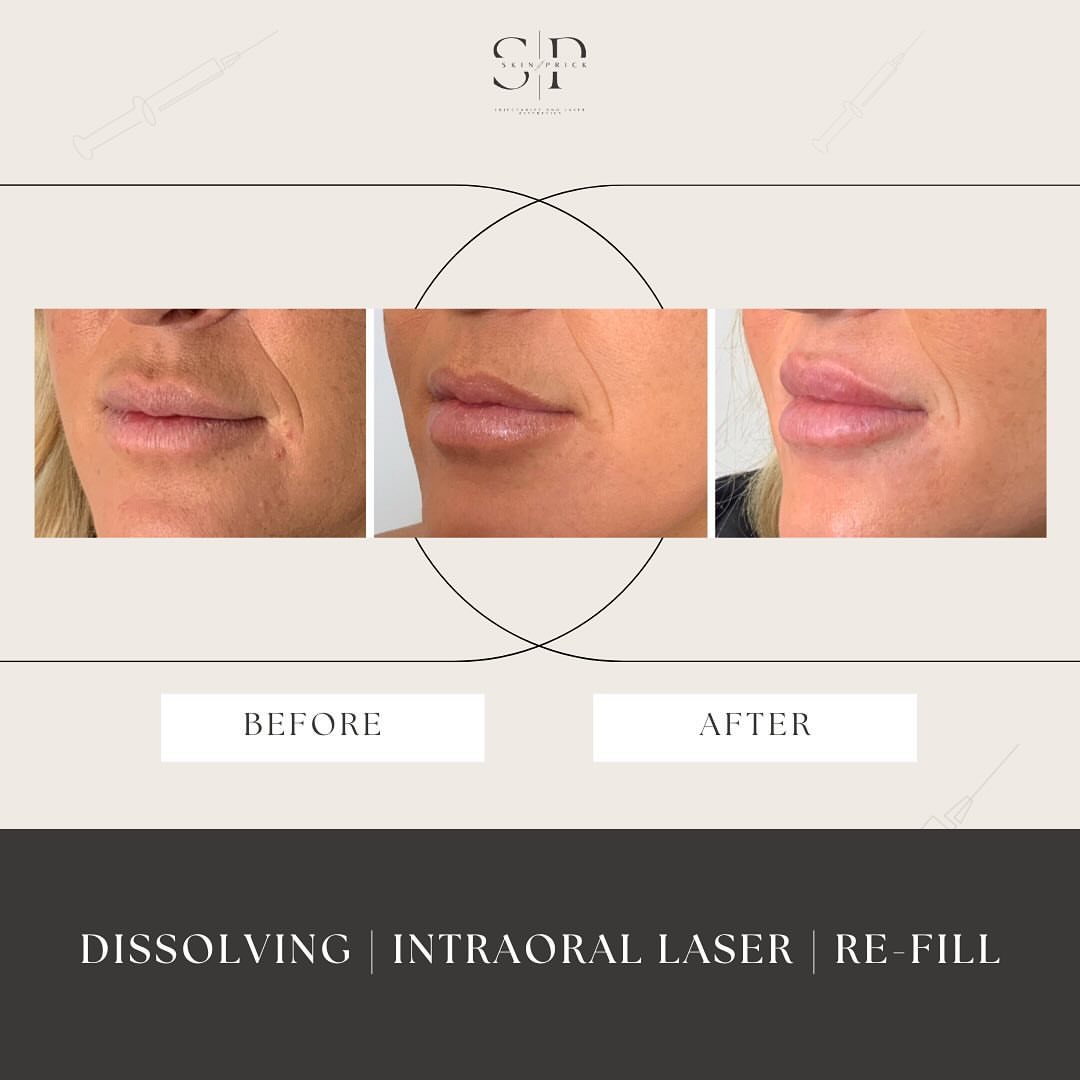 Images Skin Prick - Facial, PRP, Microneedling, Botox Toronto