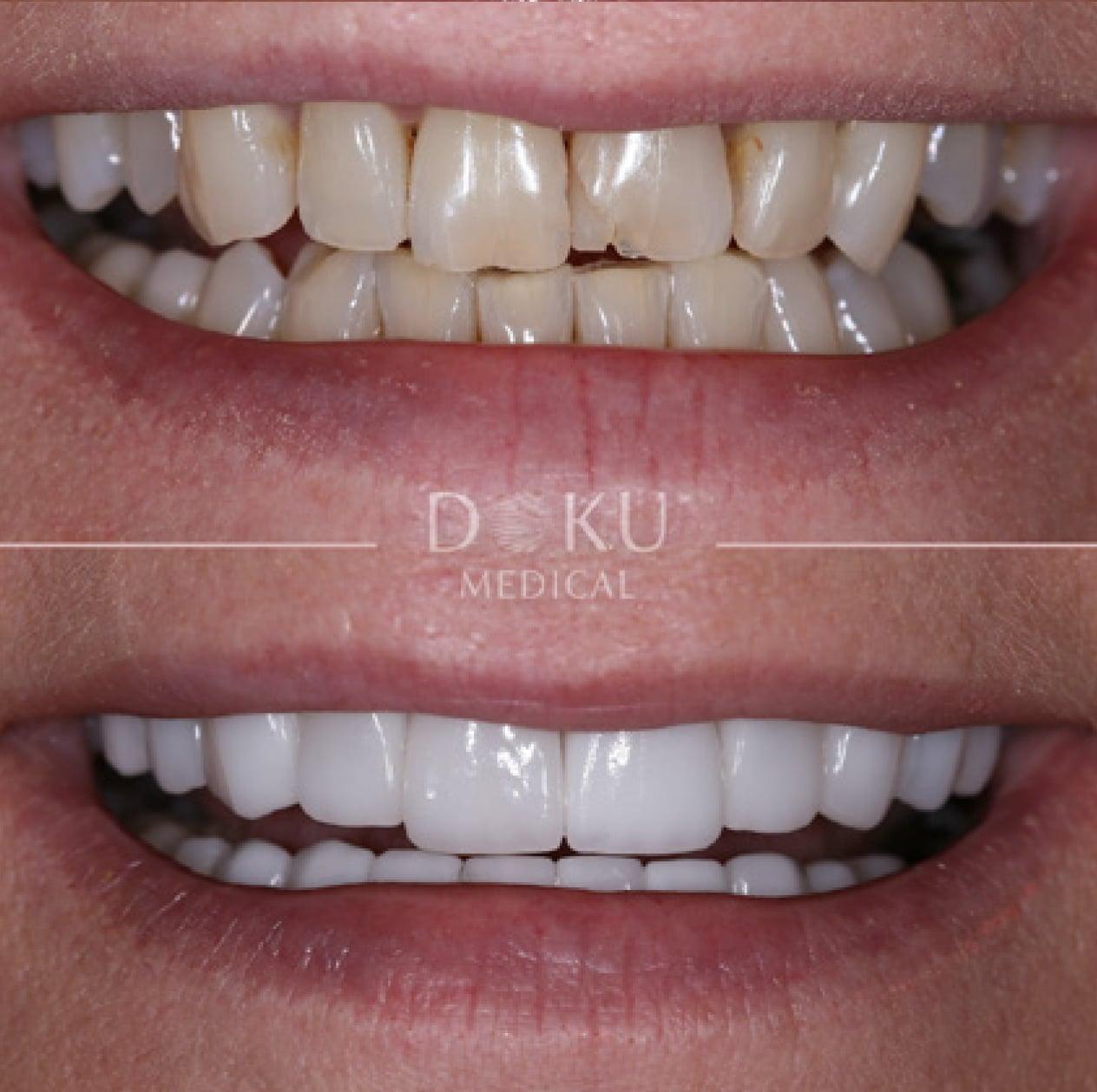 Kundenbild groß 4 Veneers & Zahnimplantate – Zähne machen lassen in der Türkei mit Fly2Smile