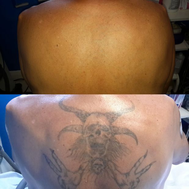 Full Back Tattoo Removal
Winter Park Tattoo Removal
407-629-0253