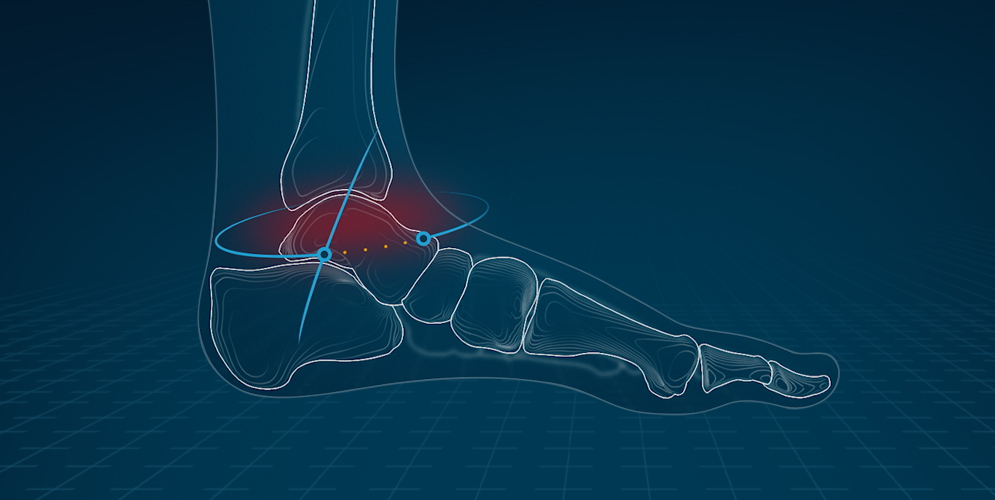 skeletal image of foot pain