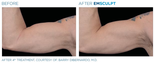 Images Columbus Emsculpt