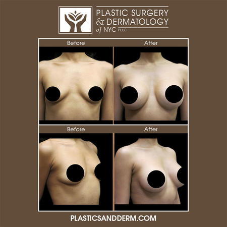 Breast augmentation can enhance the size and shape of the breasts. NYC breast surgeon, Dr. Elie Levine, works closely with patients seeking breast implants to ensure the most natural-looking results. At Plastic Surgery & Dermatology of NYC, we offer Vectra 3D Aesthetic Simulation Imaging, which allows you to preview your expected breast augmentation results before committing to surgery.