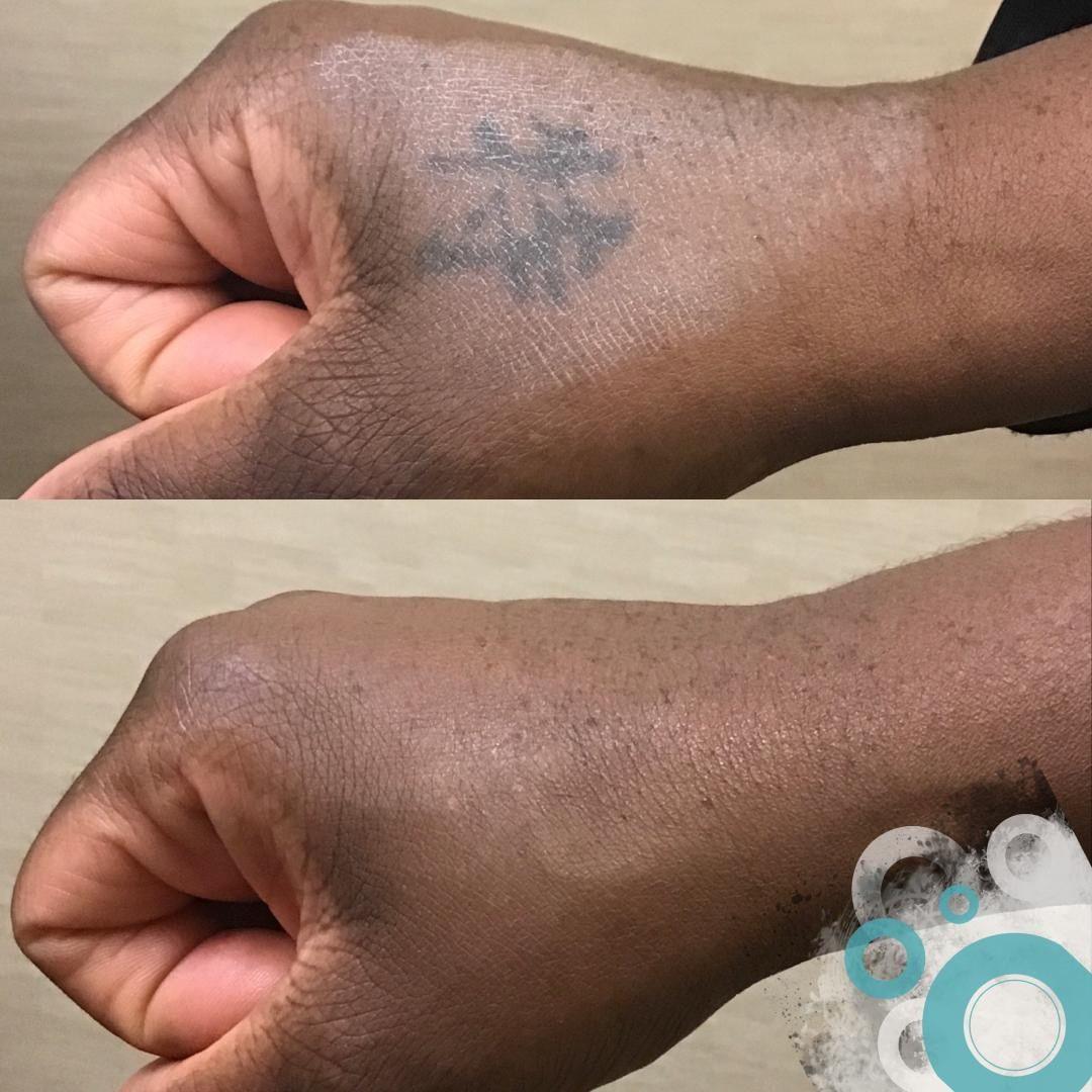 Removery Tattoo Removal & Fading à Ottawa: Before & After Hand Tattoo Removal