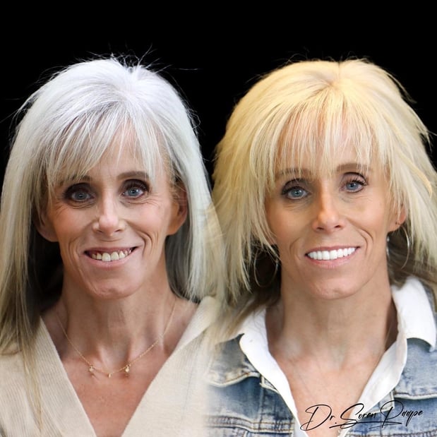 Images Smile Now Denver Dentures and Implants