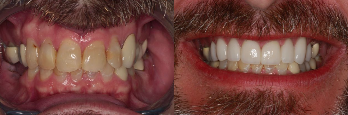 Before & After from Southern Dental Implant Center | Cordova, TN, , Dentist