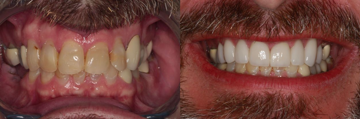 Before & After from Southern Dental Implant Center | Cordova, TN