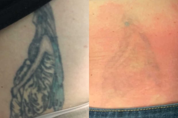 Images TakeTatt Tattoo Removal